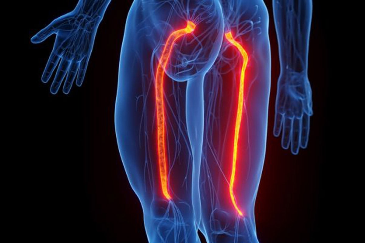 Sciatica